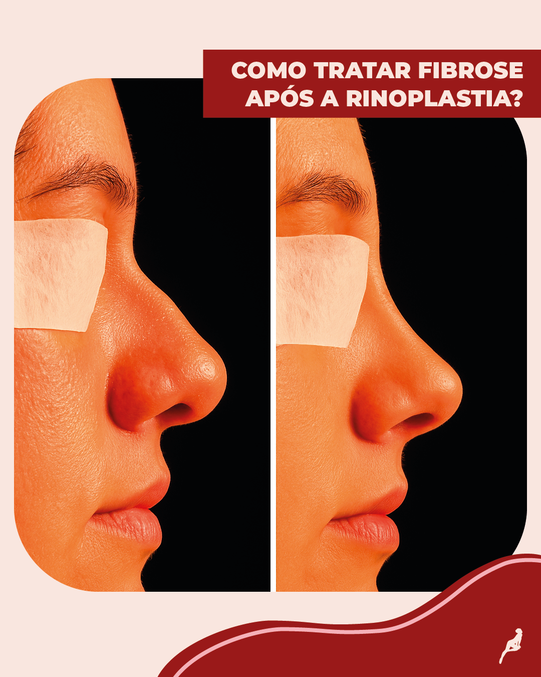 Fibrose após rinoplastia: O que é e como tratar? fibrose após rinoplastia