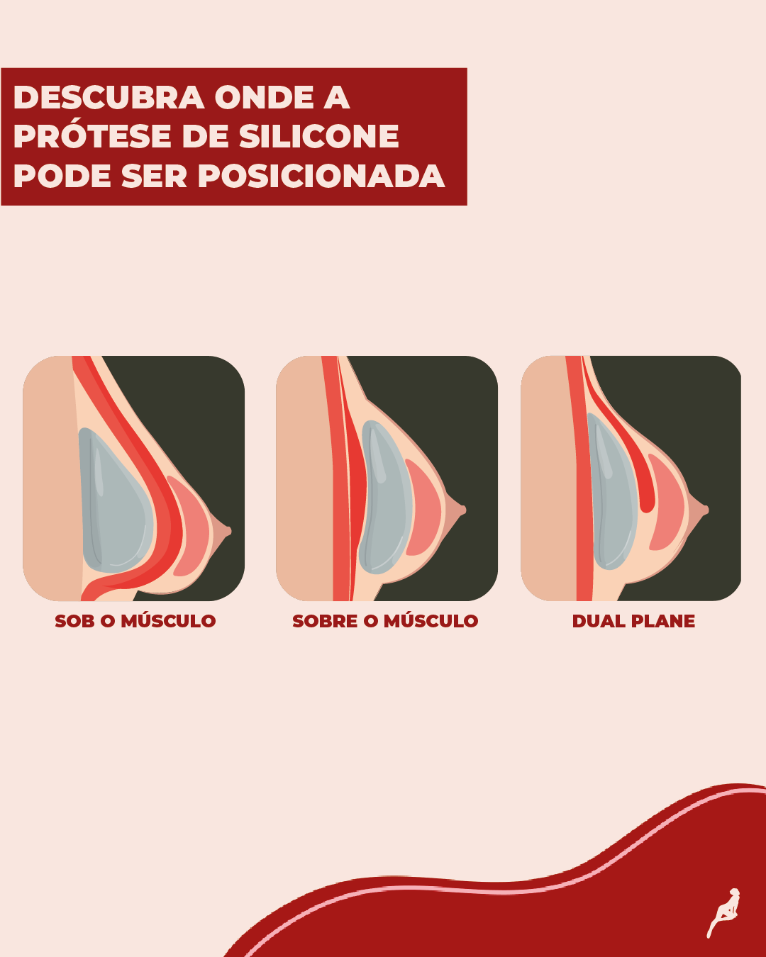 Locais da colocação da prótese de silicone Ilustração que mostra os locais onde a prótese de silicone pode ser posicionada