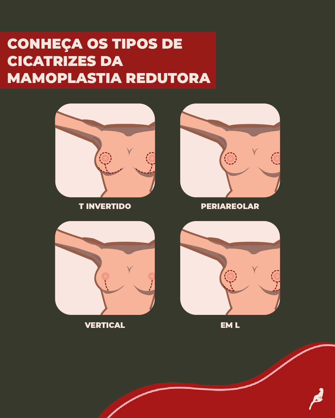 Como é a cicatriz da mamoplastia redutora? Ilustração que mostra os tipos de cicatrizes da mamoplastia redutora, T invertido, periareolar, vertical e em L