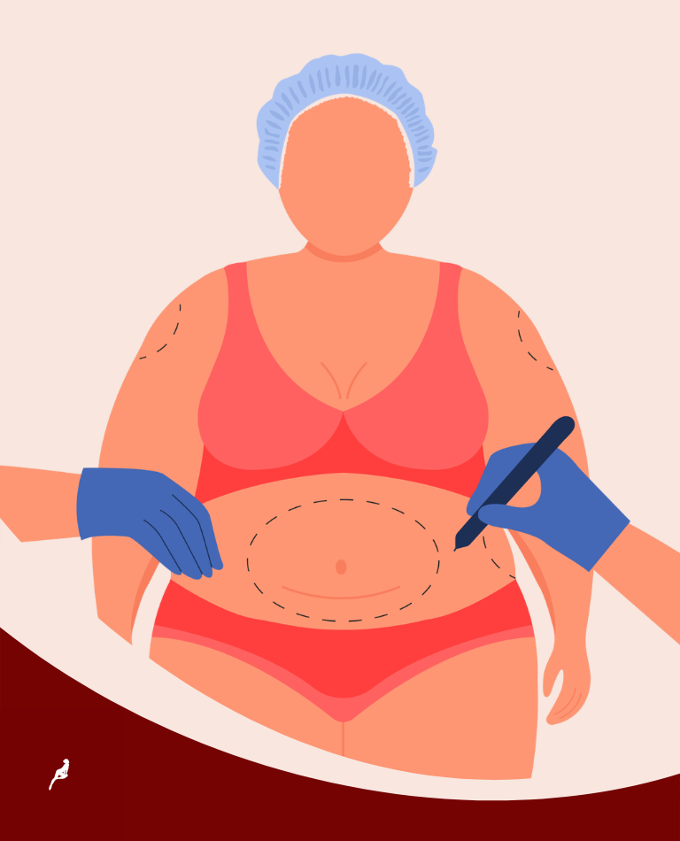 marcações mini abdominoplastia