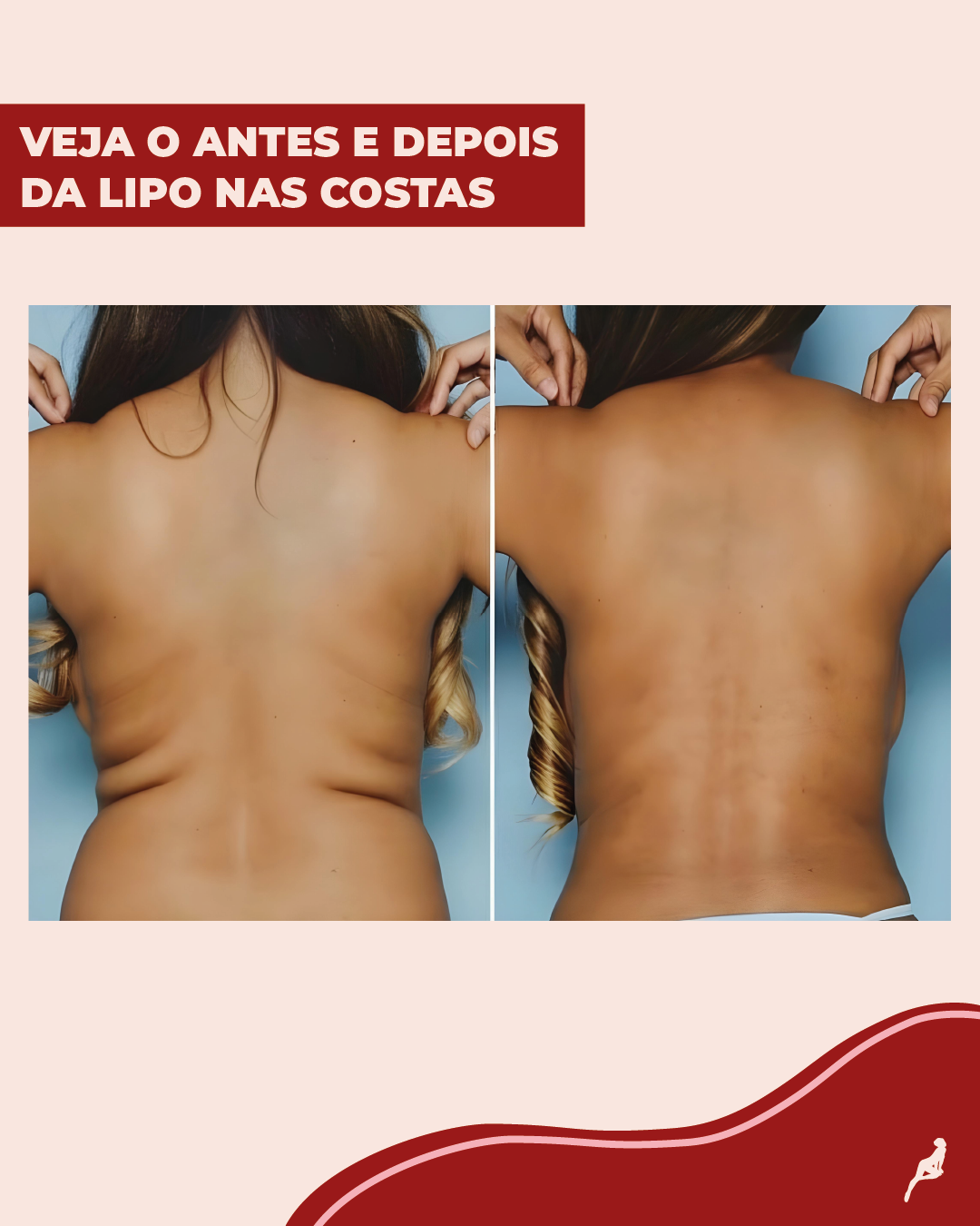 antes e depois da lipo nas costas antes e depois da lipo nas costas