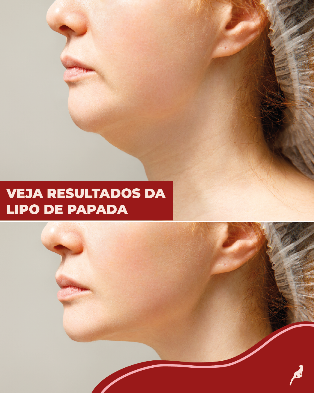 Lipo de papada imagem de antes e depois da lipo de papada