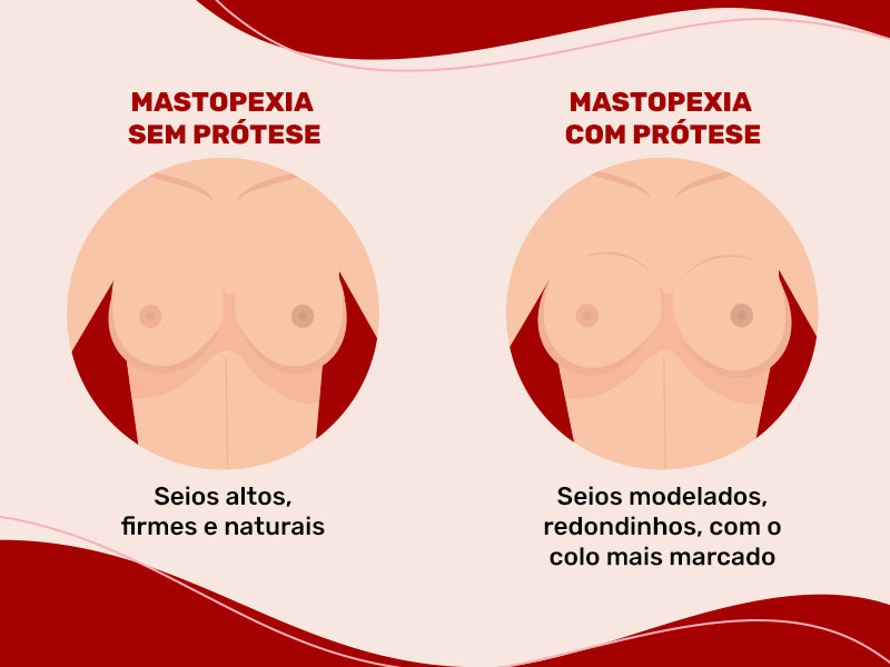 mastopexia com ou sem prótese