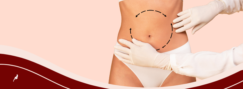 cirurgião marcação umbigo onfaloplastia
