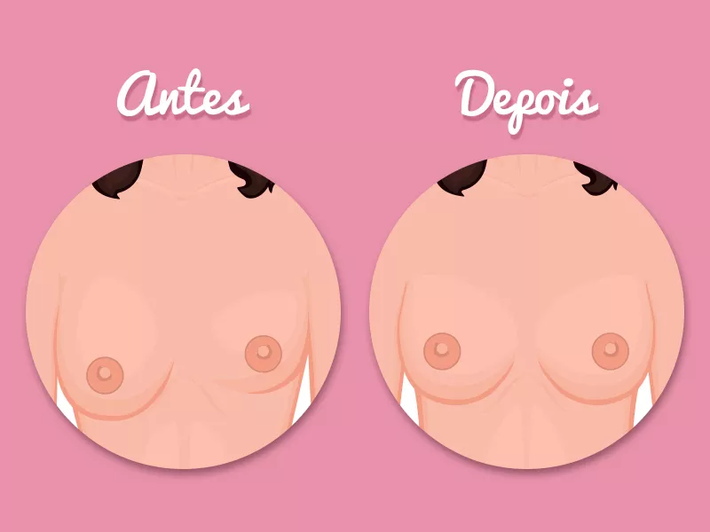 Como é o antes e depois da assimetria mamária? fotos assimetria mamaria antes depois