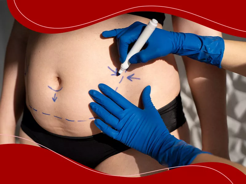 Foto de uma barriga gordinha com marcações de canetão para a realização da mini lipo