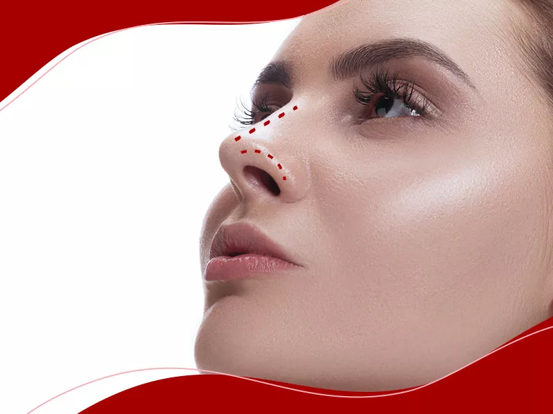 Imagem de mulher com as marcações no nariz, onde será realizada a rinoplastia