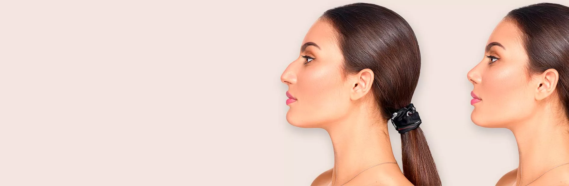 rinoplastia antes depois