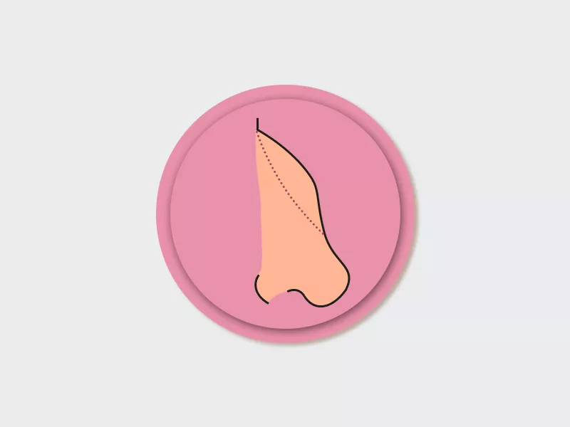 Ilustração de um nariz com giba nasal grande