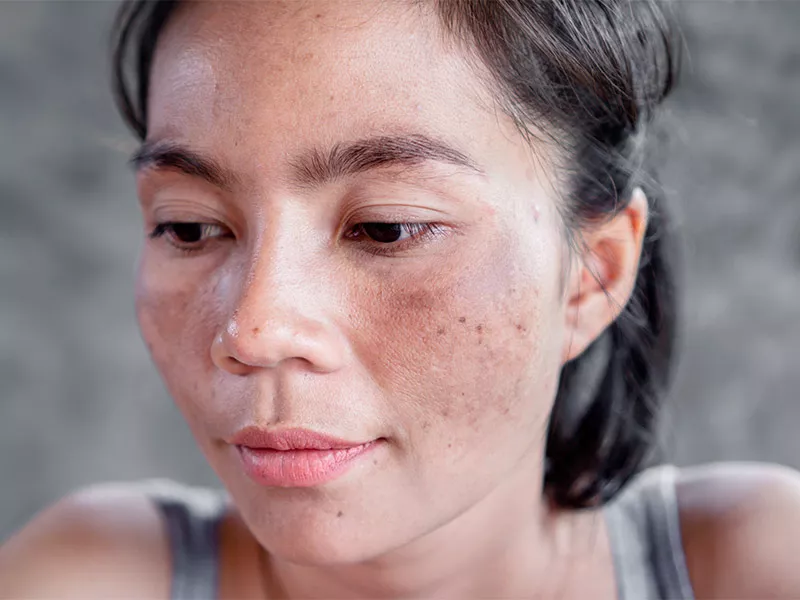 O ativo é indicado para tratar melasma? Foto de uma mulher com manchas no rosto e expressão de dúvida sobre o ácido hialurônico tirar melasma
