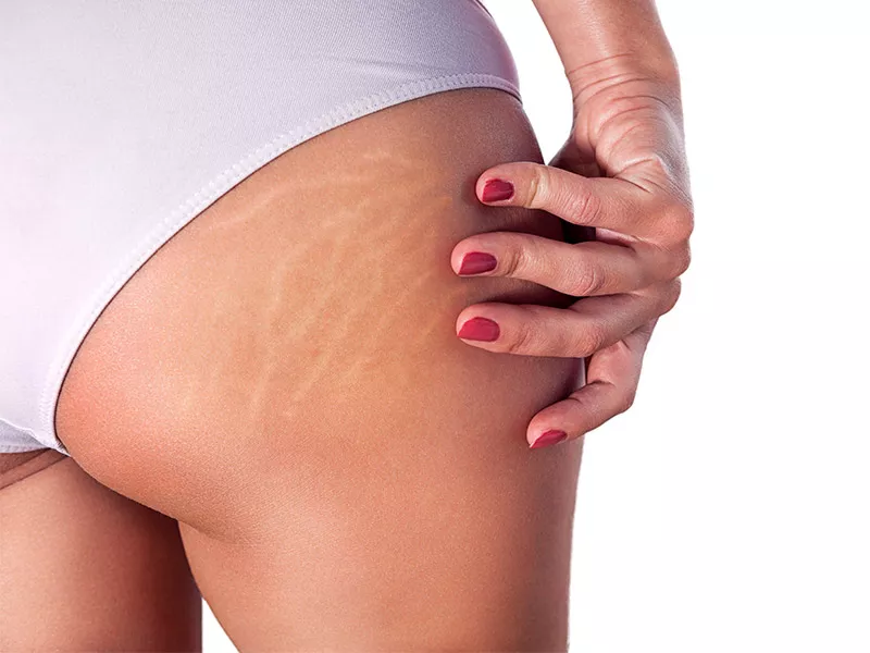 O ativo ajuda a amenizar as estrias? Imagem de uma mulher com estriar
