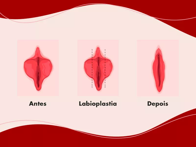 Como é feita a labioplastia para lábios vaginais grandes? ilustração mostrando o passo a passo da cirurgia de labioplastia, com o corte e a sutura da região