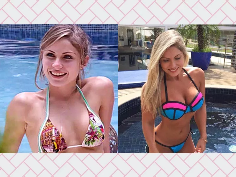 Prótese de silicone de 400ml: antes e depois da ex-BBB Renatinha silicone 400ml