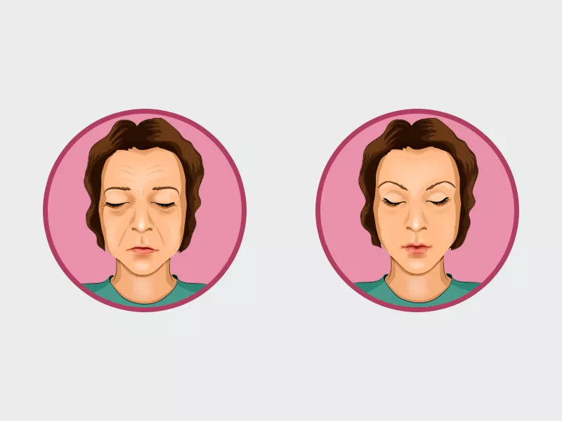 Ilustração exemplificando como é o antes e depois da ritidoplastia