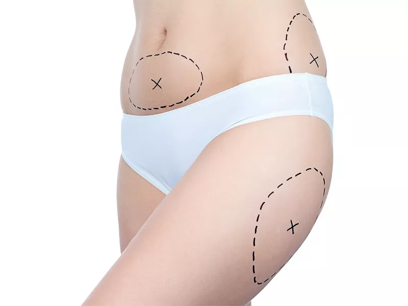 mulher com marcações de lipoaspiração nos lugares onde tem lipoma