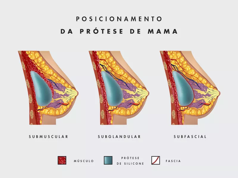 ilustração de uma mama mostrando o posicionamento da prótese mama