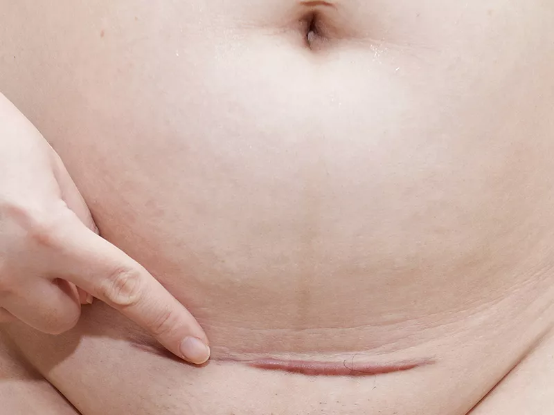 O que é o queloide? fita de silicone para queloide