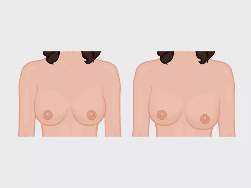 Deslocamento da prótese de silicone deslocamento da protese