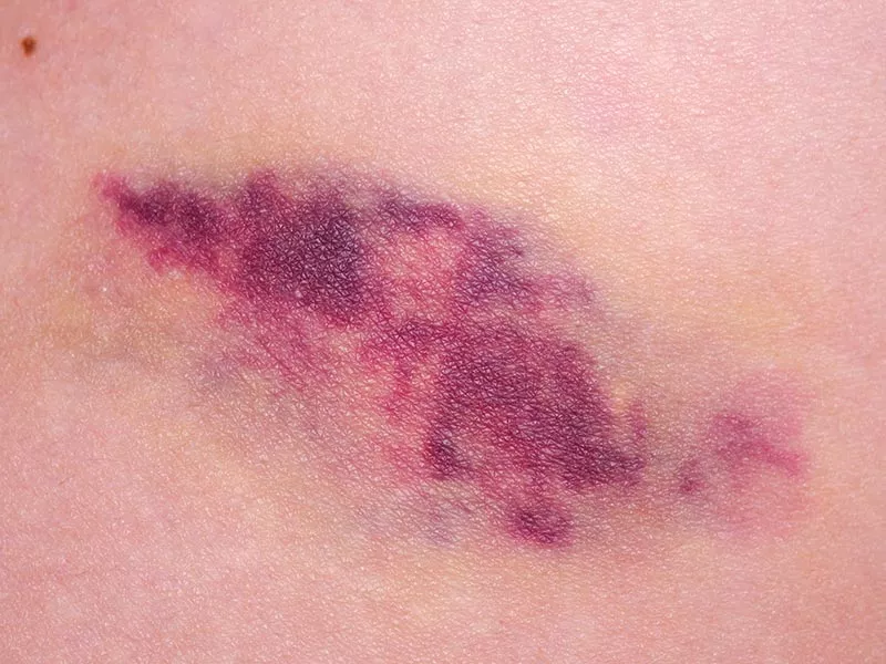 É comum ficar com vários hematomas após a lipoaspiração? hematomas apos lipo
