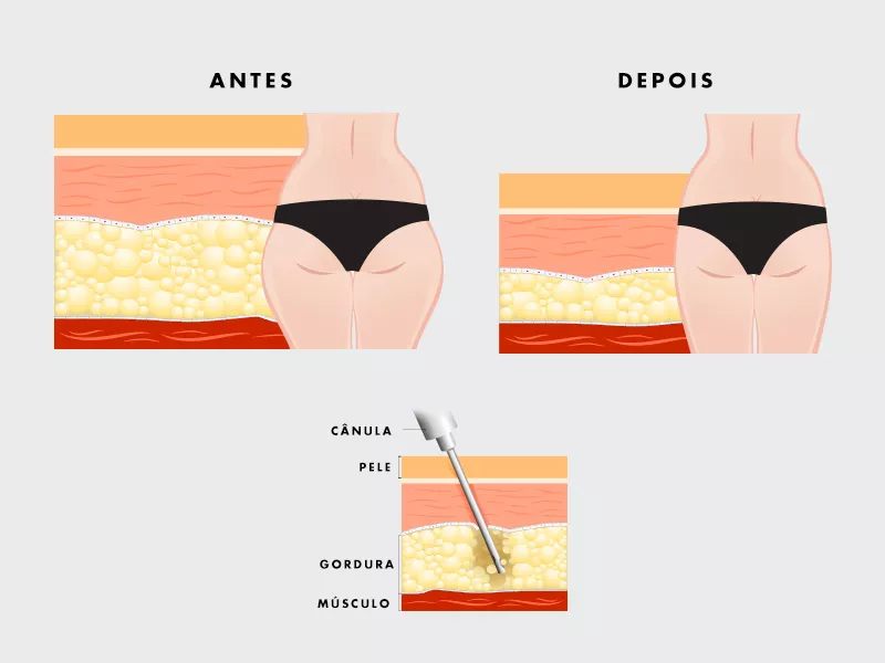 cirurgia tirar culotes cirurgia tirar culotes