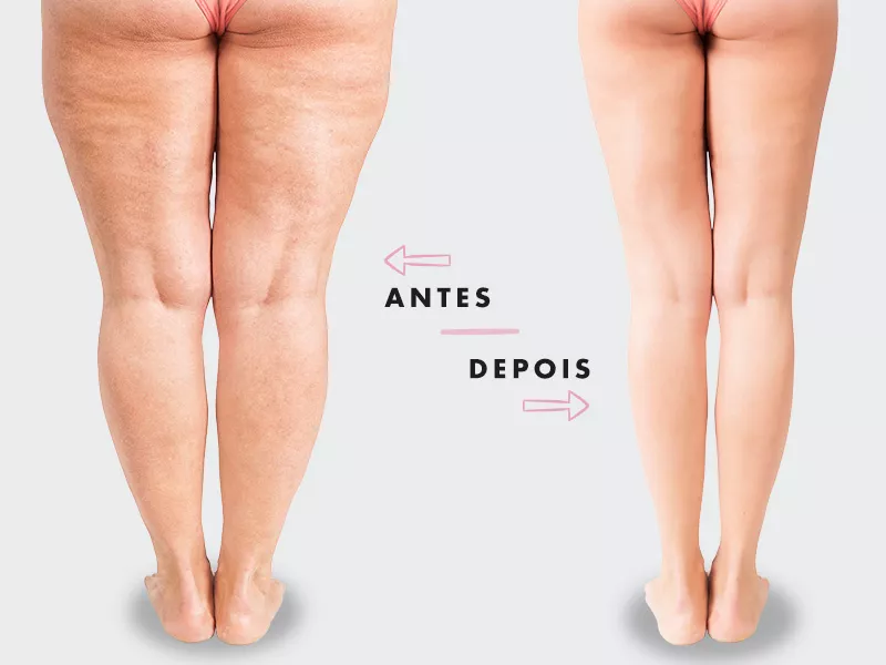 Lipo no culote: antes e depois lipoaspiracao culote antes depois fotos