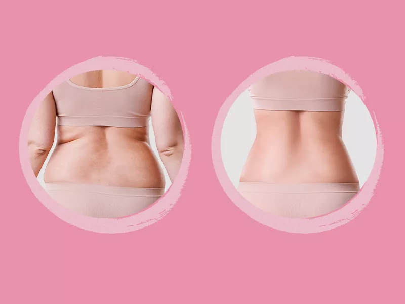 Lipo nas costas: fotos de antes e depois duas fotos, lado a lado, em um fundo rosa, mostrando o antes e depois da lipoaspiração nas costas, onde o excesso de gordura vai embora
