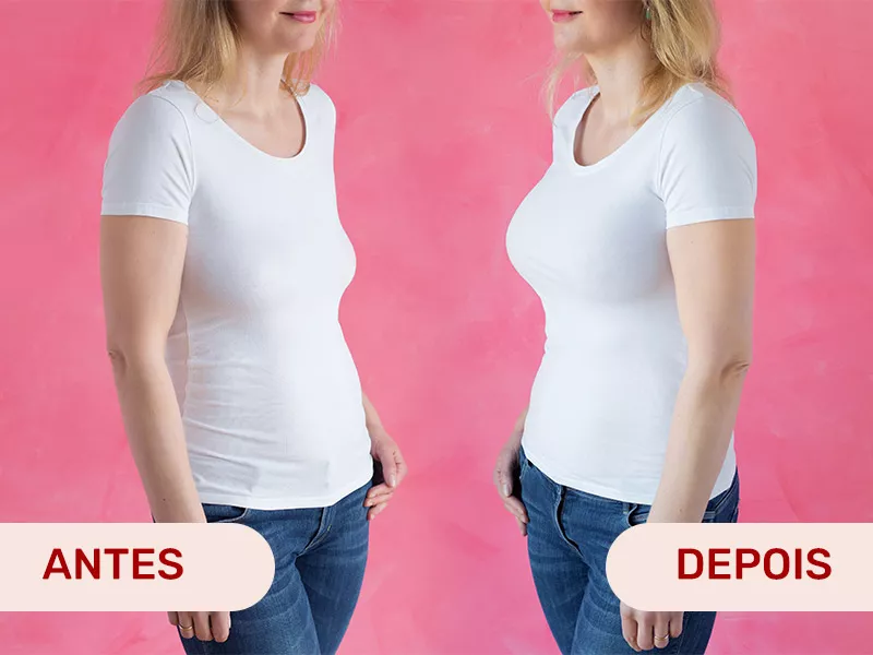 E como fica o antes e depois da cirurgia para diminuir os seios caídos? Duas fotos de mulher com o corpo voltado para a diagonal, para mostrar o resultado da mastopexia com prótese