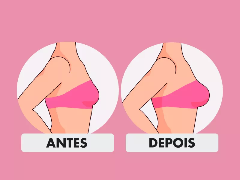 Fotos de Silicone antes e depois de 280ml... silicone antes depois 280ml