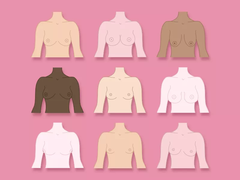 O que é mamoplastia? Ilustração que mostra os tipos de cirurgia de mama