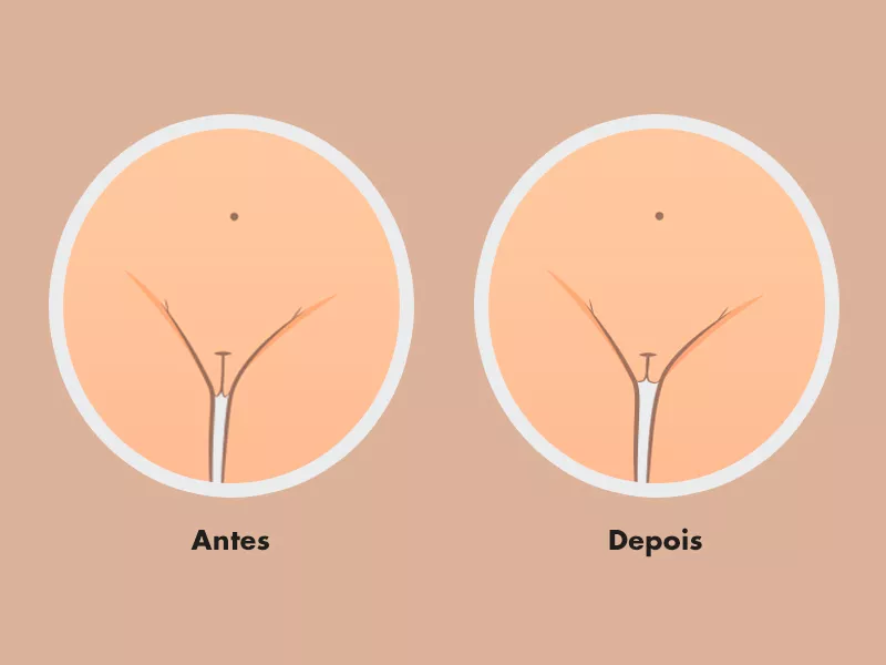 labioplastia grandes lábios antes depois