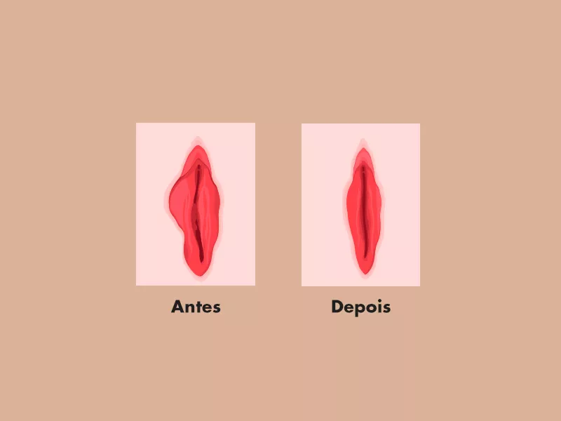 hipertrofia pequenos lábios antes depois