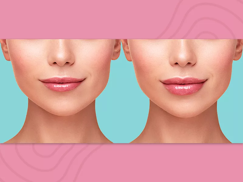 antes e depois do preenchimento labial