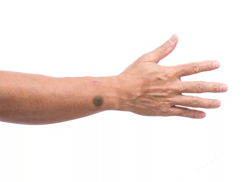 fundo branco com uma pessoa com verruga no braço, uma das partes do corpo onde essa lesão aparece