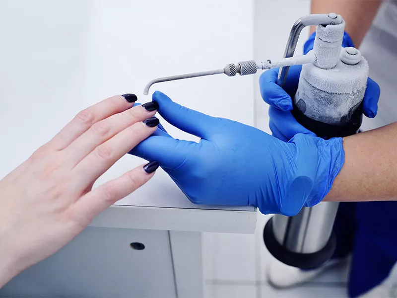 Imagem de uma mão com verrugas nos dedos e uma profissional segurando o aparelho de crioterapia para iniciar o tratamento 
