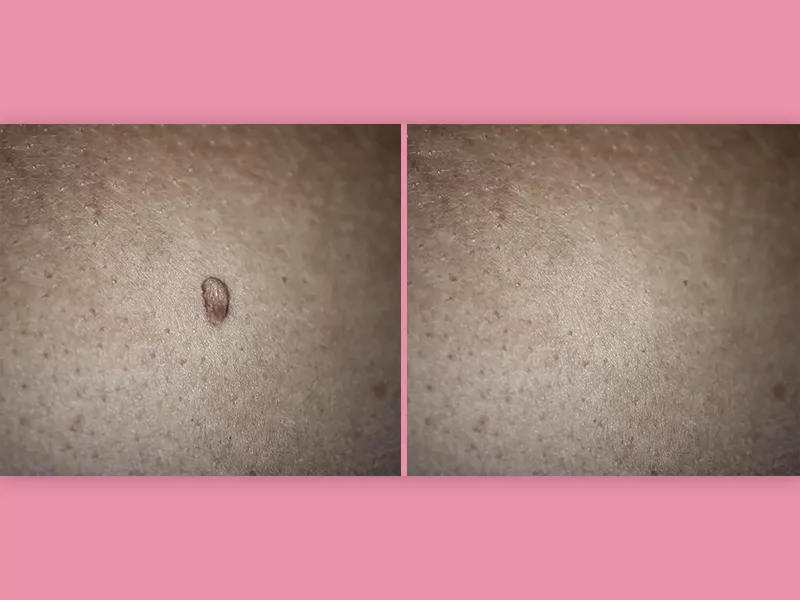 Imagem com o antes e depois da retirada de verrugas