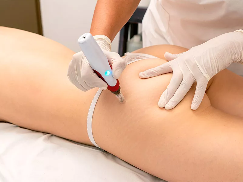 O MICROAGULHAMENTO EM ESTRIAS FUNCIONA? mulher fazendo microagulhamento para estrias no bumbum