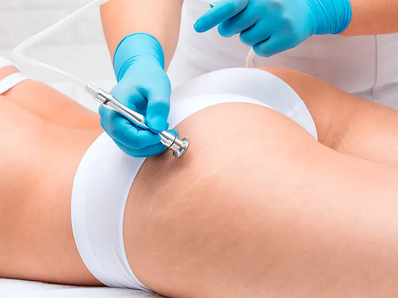 COMO É FEITO O PEELING DE DIAMANTE NAS ESTRIAS? mulher fazendo peeling de diamante para estrias no bumbum