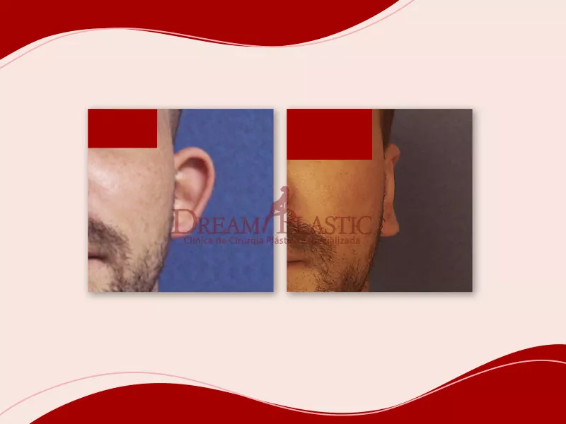 Imagem exemplificando o que é otoplastia e mostrando o resultado do procedimento em um paciente branco, de 28 anos, que diminuiu as orelhas. O paciente está posicionado de frente nas fotos de antes e depois.