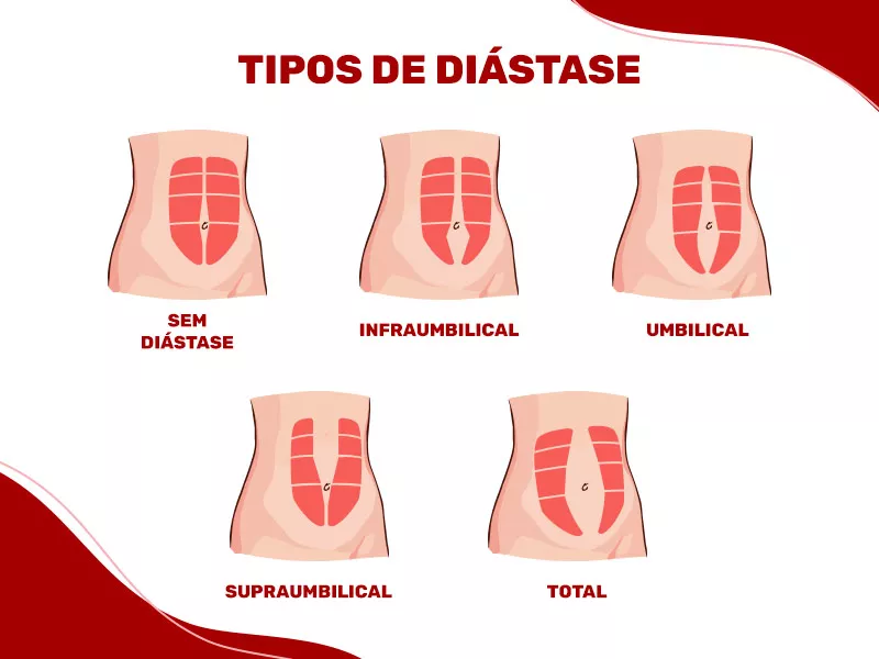Quais são os tipos de diástase? Ilustração que mostra como fica o músculo abdominal em cada um dos tipos de diástase