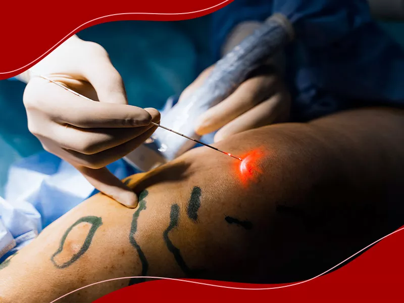 O que é endolift? Médico fazendo endolifting em paciente