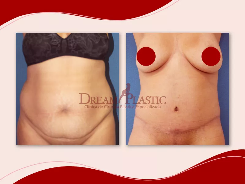 Como afinar a cintura? Imagem de antes e depois de como afinar a cintura