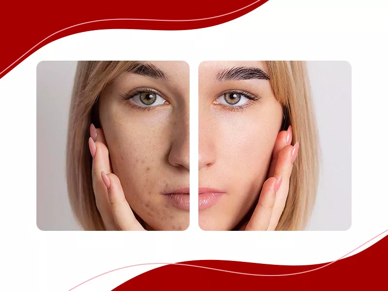 Antes e depois de mulher que fez limpeza de pele