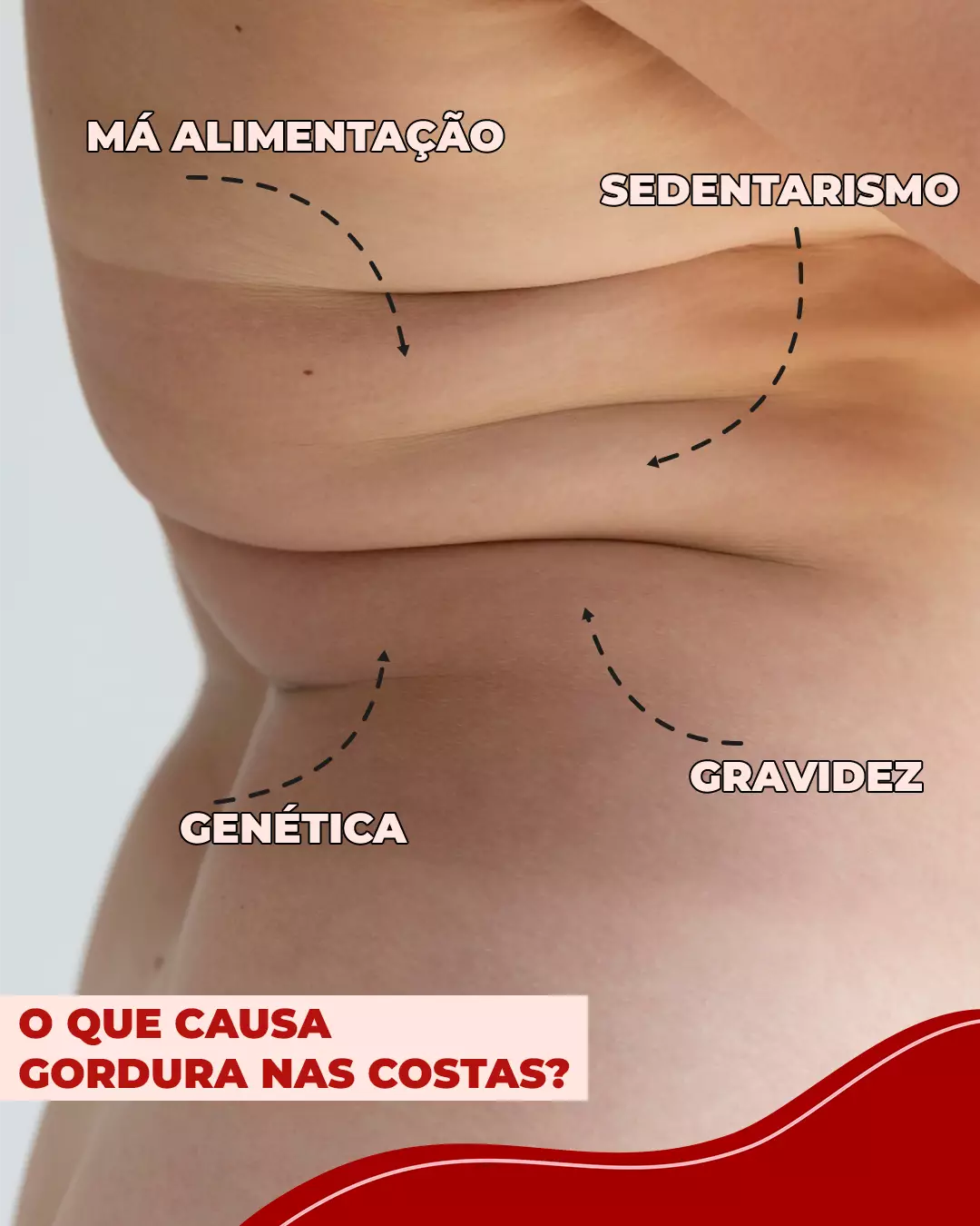 O que causa gordura nas costas? Costas com dobrinhas de gordura, com setas apontando para as suas causas, como genética e sedentarismo